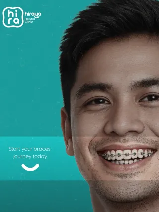 Dental braces